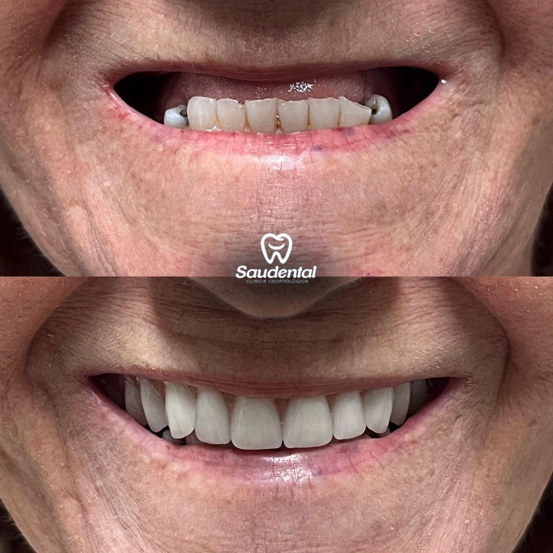 Saudental Abreu e Lima. Prótese Dentária #1.1