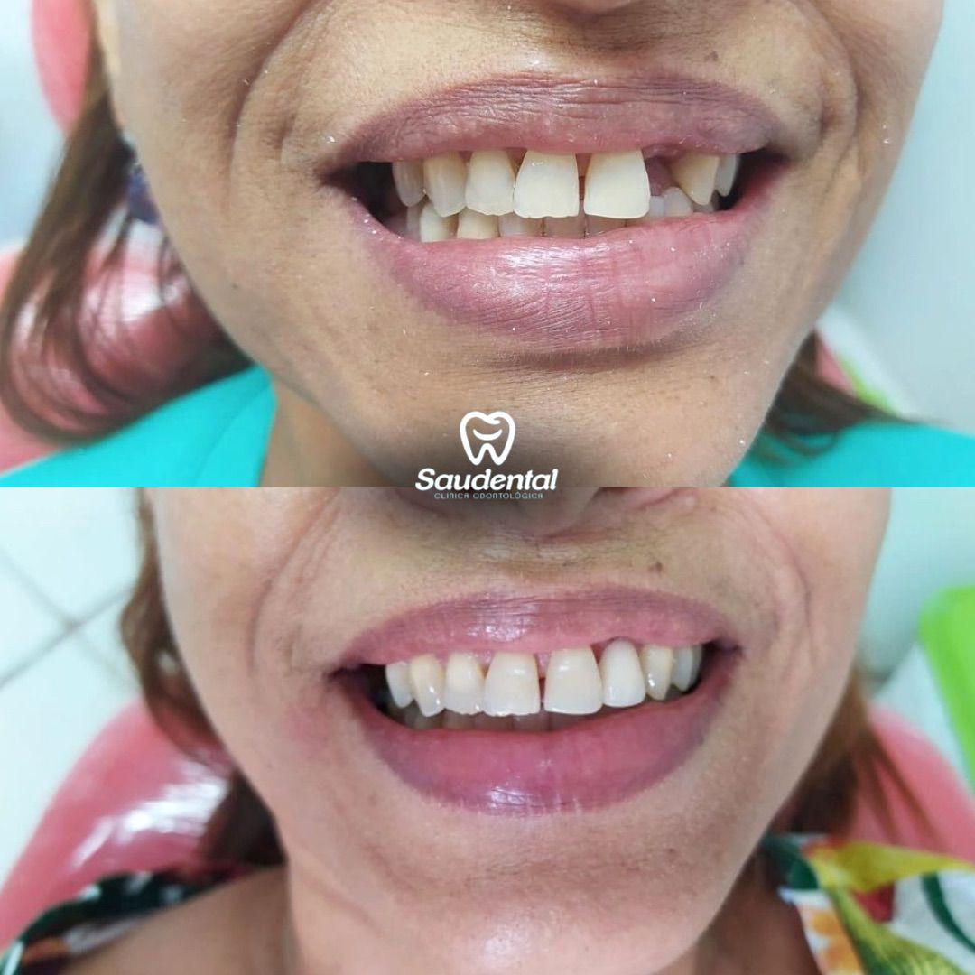 Saudental Abreu e Lima. Prótese Dentária #2.1