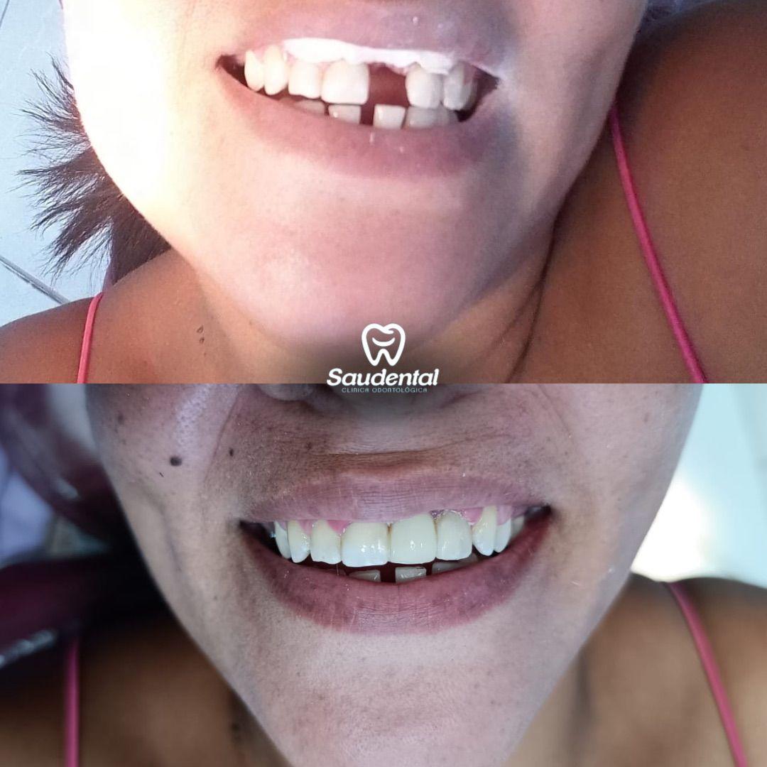 Saudental Abreu e Lima. Prótese Dentária #3.1