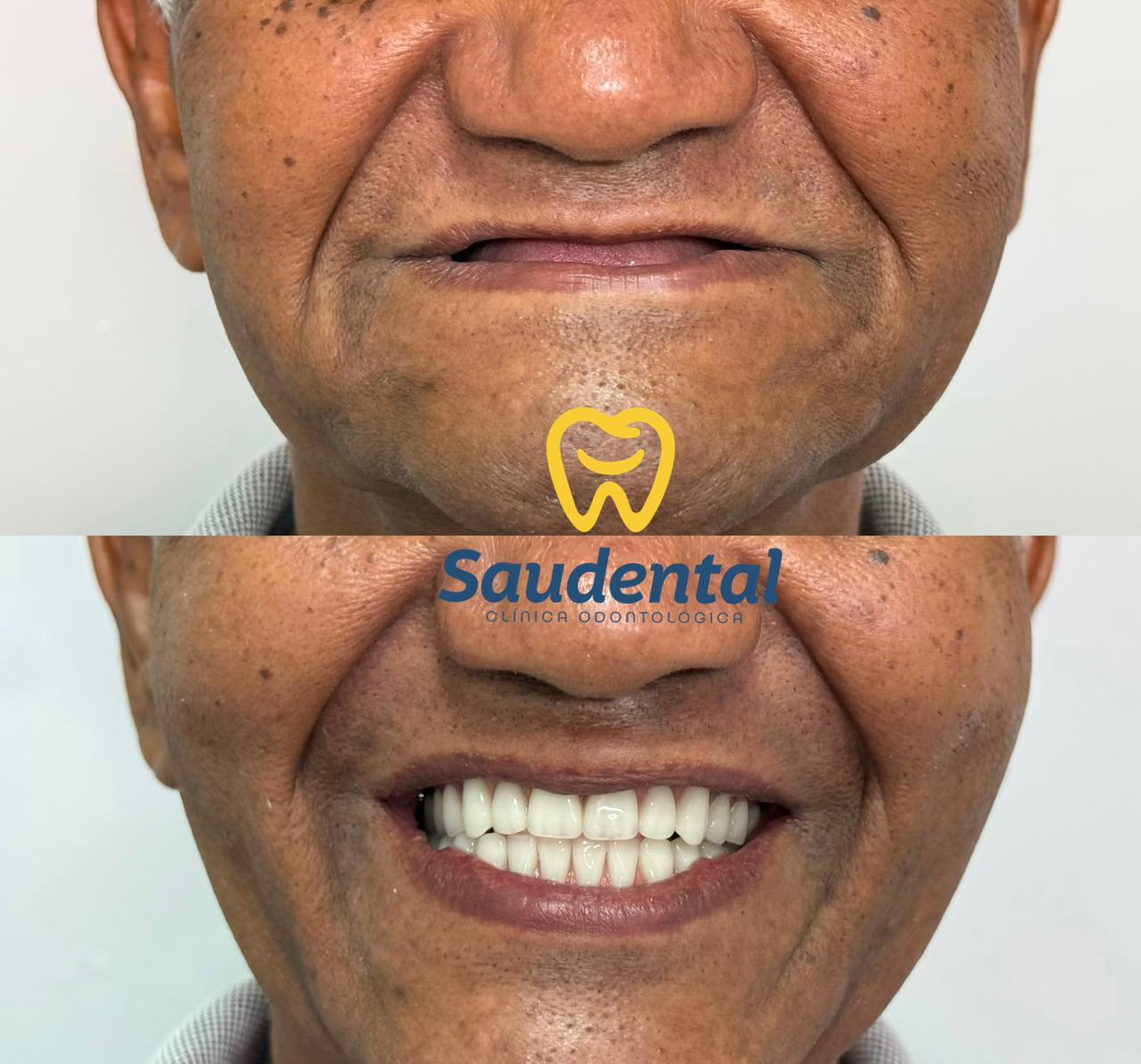 Saudental Abreu e Lima. Prótese Dentária #4.1