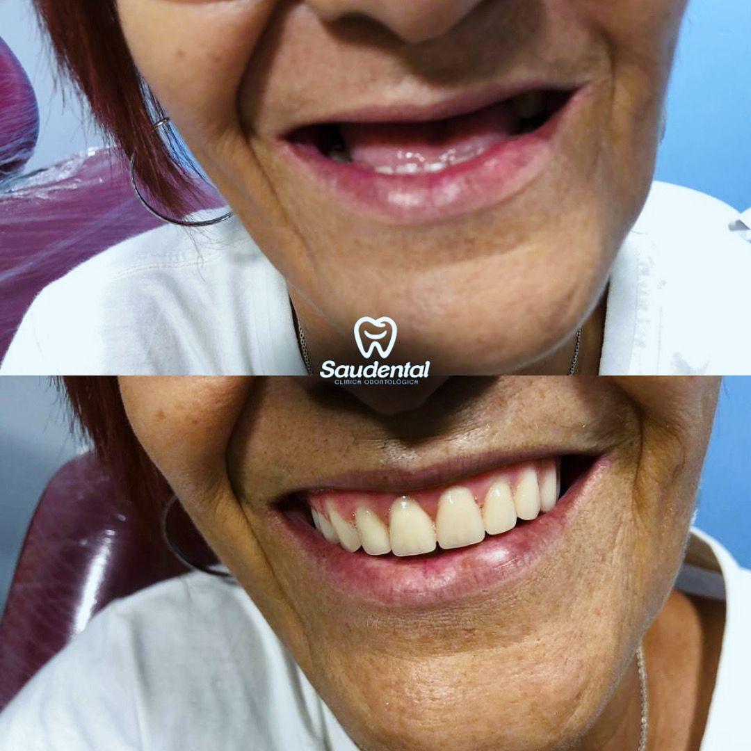 Saudental Abreu e Lima. Prótese Dentária #5.1